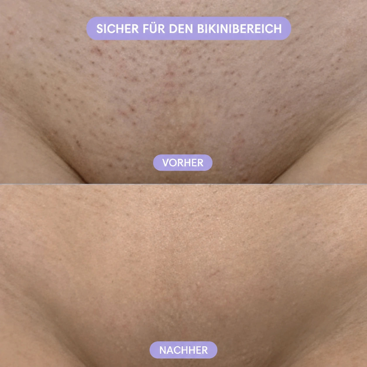 Kristall-Haarentferner