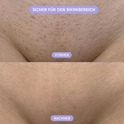 Kristall-Haarentferner
